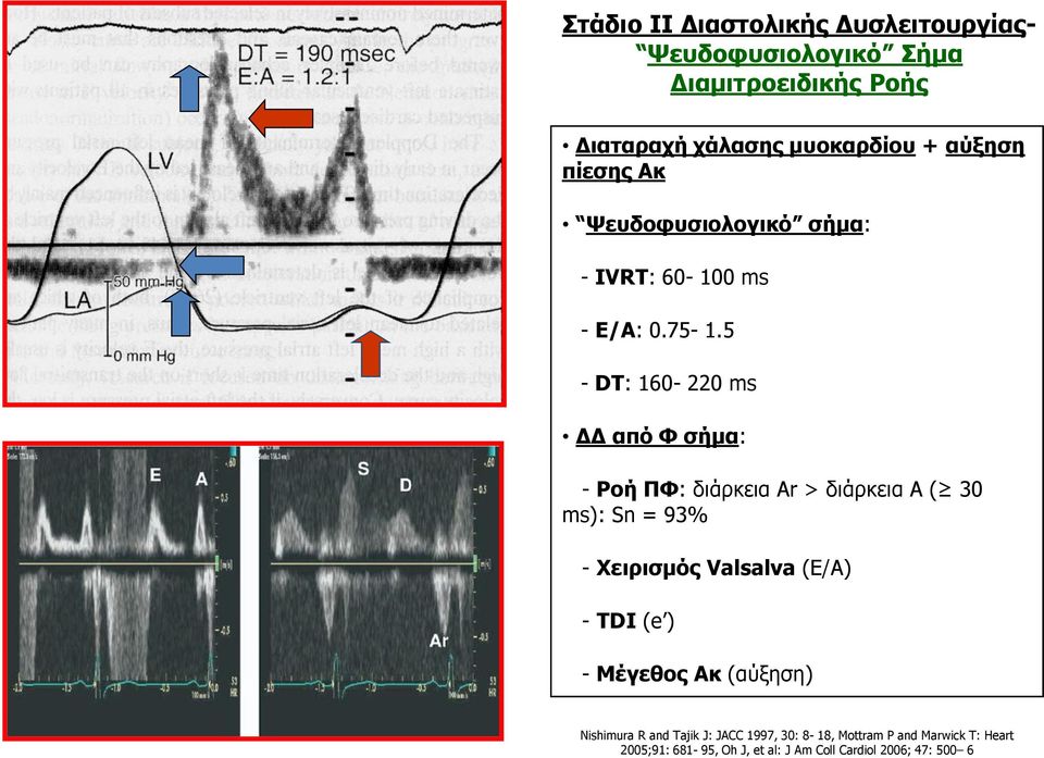 5 - DT: 160-220 ms ΔΔ από Φ σήμα: - Ροή ΠΦ: διάρκεια Ar > διάρκεια A ( 30 ms): Sn = 93% - Χειρισμός Valsalva (Ε/Α) -