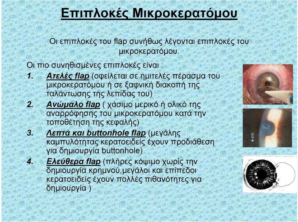 Ανώμαλο flap ( χάσιμο μερικό ή ολικό της αναρρόφησης του μικροκερατόμου κατά την τοποθέτηση της κεφαλής) 3.