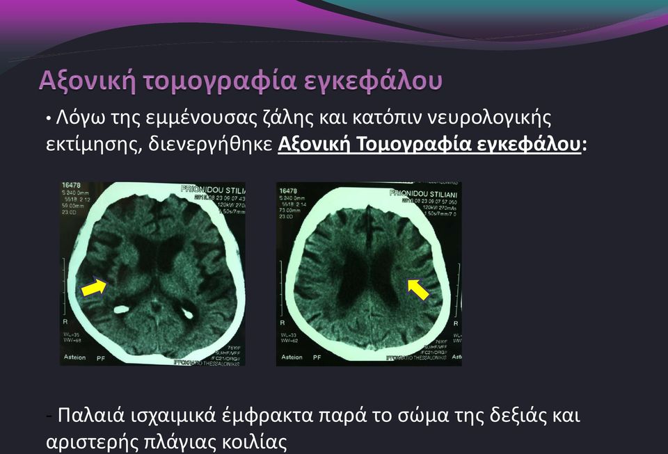 Τομογραφία εγκεφάλου: - Παλαιά ισχαιμικά