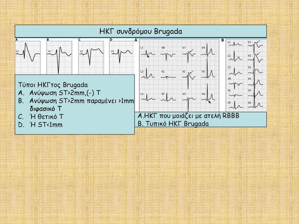 Ανύψωση ST>2mm παραμένει >1mm διφασικό Τ C.