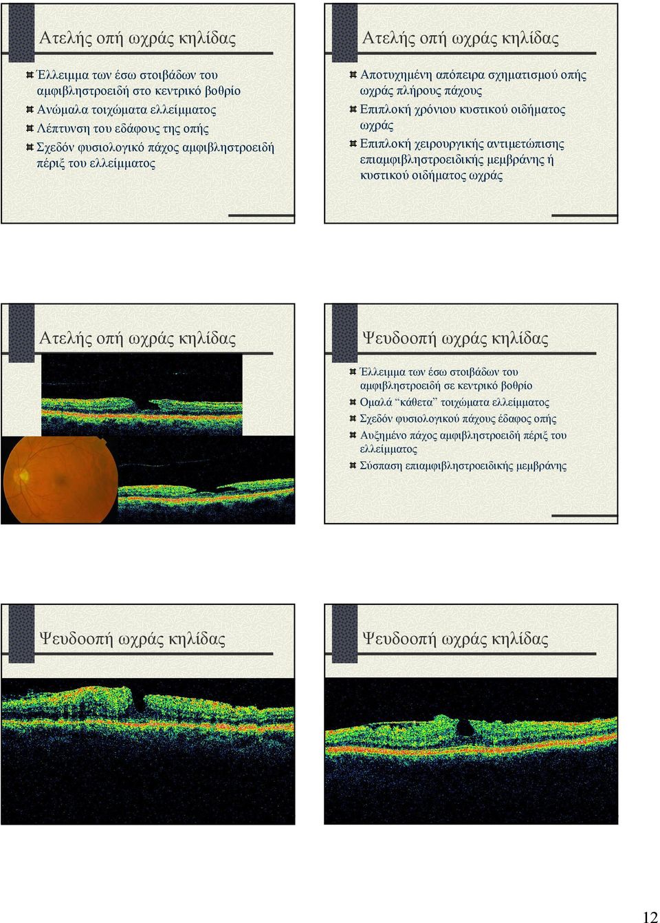 αντιµετώπισης επιαµφιβληστροειδικής µεµβράνης ή κυστικού οιδήµατος ωχράς Ατελής οπή ωχράς κηλίδας Ψευδοοπή ωχράς κηλίδας Έλλειµµα των έσω στοιβάδων του αµφιβληστροειδή σε κεντρικό βοθρίο