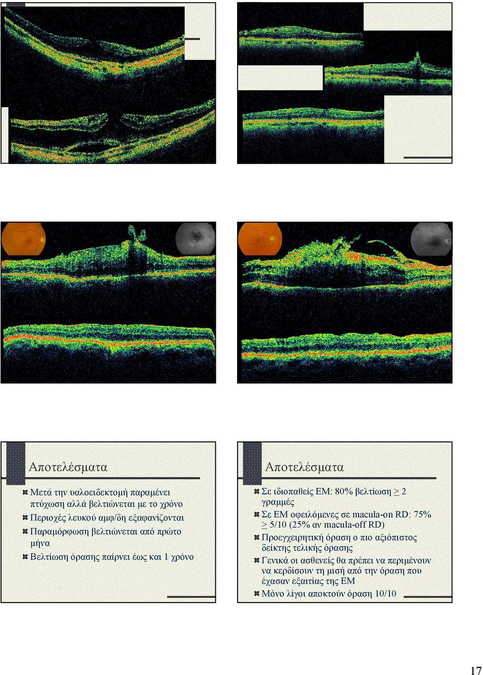 2 γραµµές Σε ΕΜ οφειλόµενες σε macula-on RD: 75% > 5/10 (25% αν macula-off RD) Προεγχειρητική όραση ο πιο αξιόπιστος δείκτης τελικής όρασης