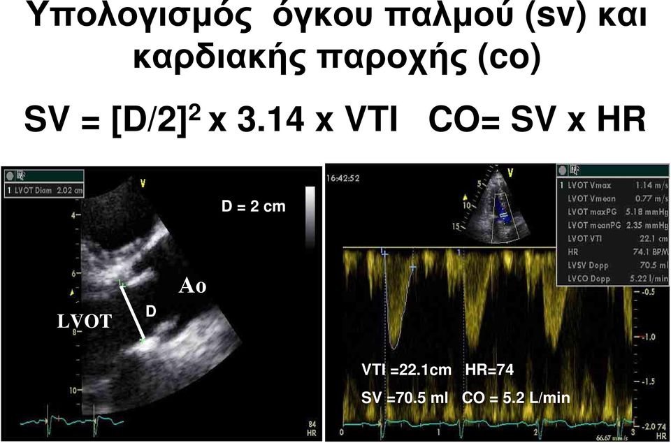 14 x VTI CO= SV x HR D = 2 cm LVOT D Αο