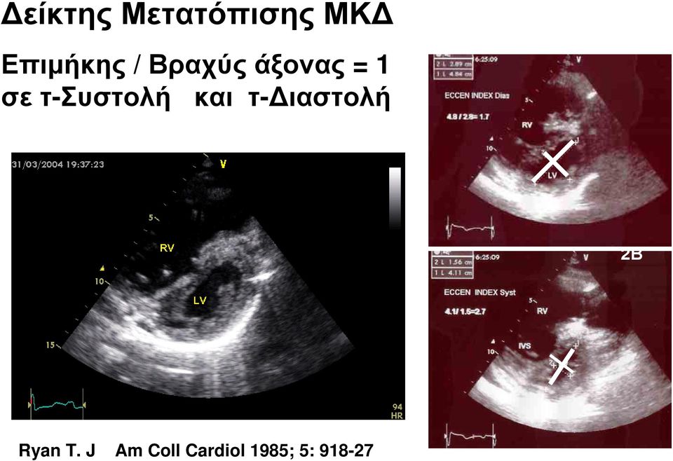 τ-συστολή και τ-διαστολή 1 2Β