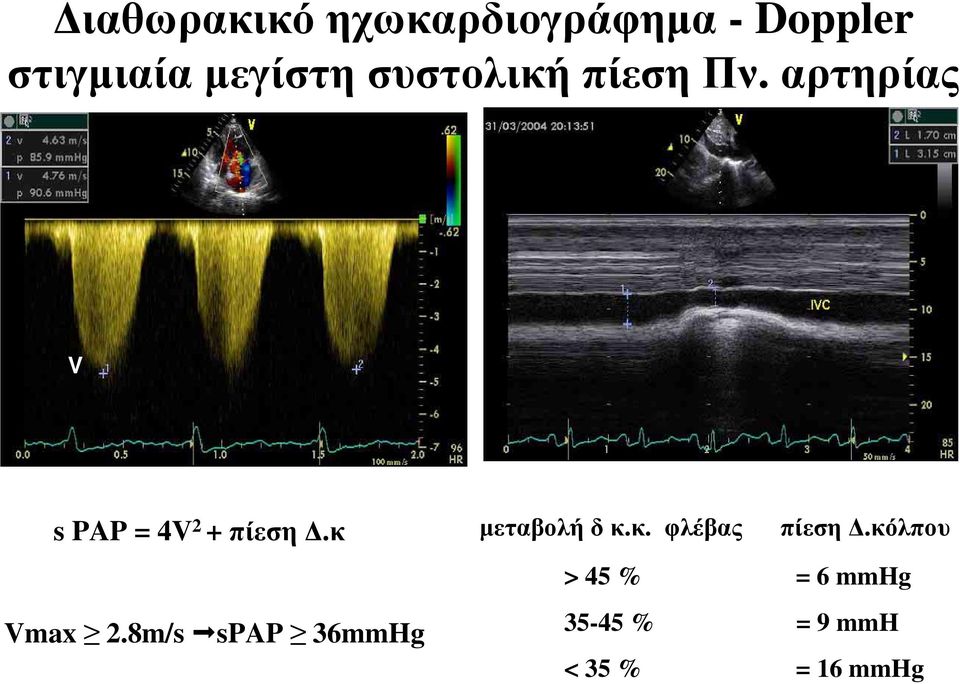 αρτηρίας V spap = 4V 2 + πίεση Δ.κ Vmax 2.