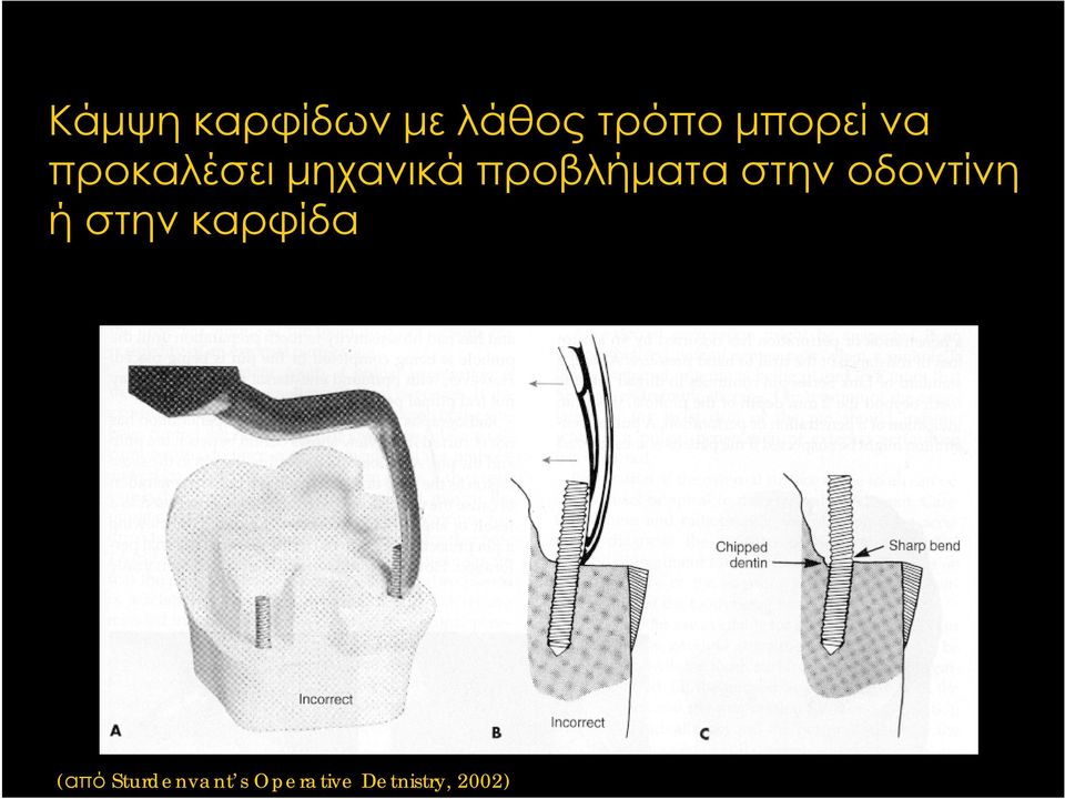 στην οδοντίνη ή στην καρφίδα (από