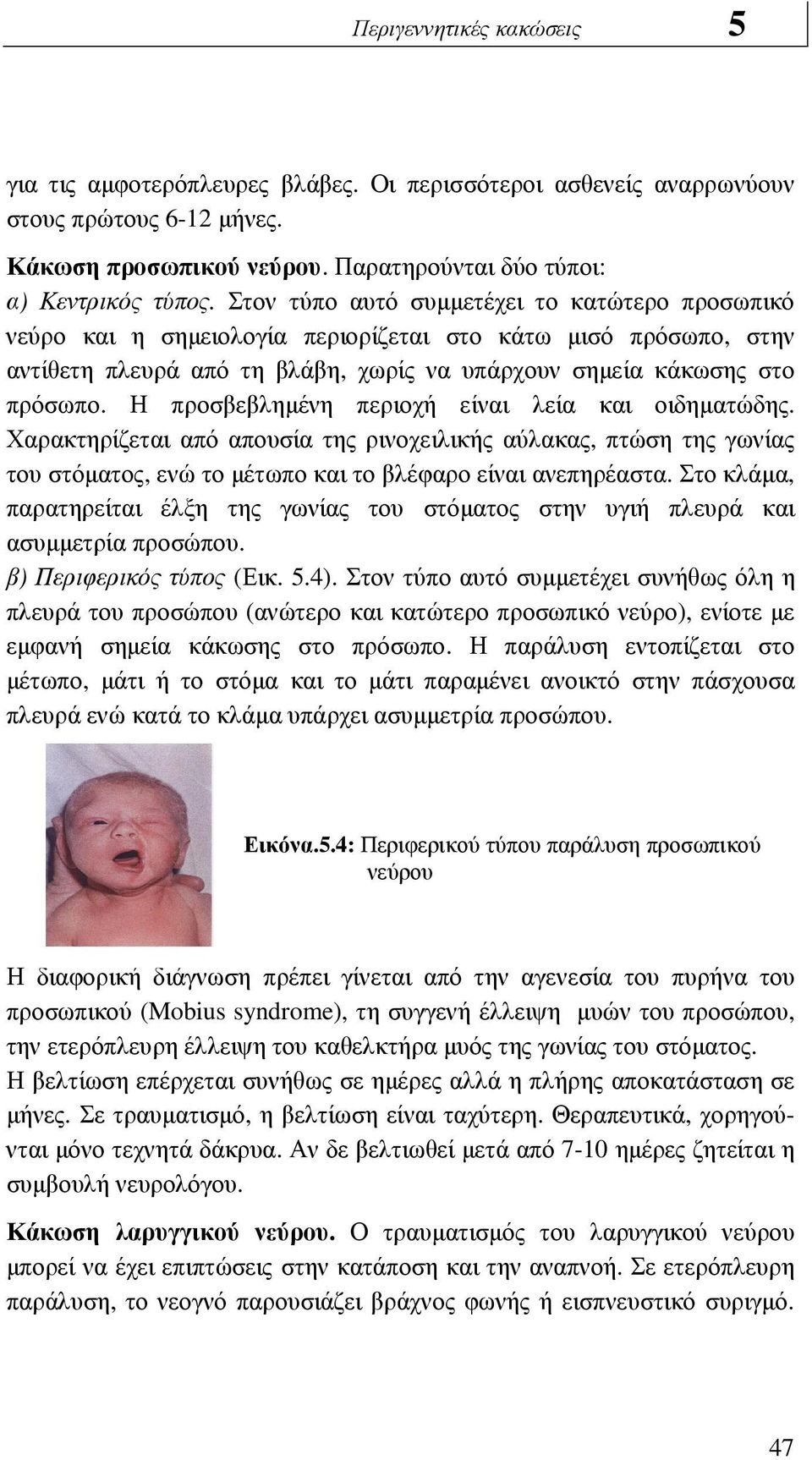 Η προσβεβληµένη περιοχή είναι λεία και οιδηµατώδης. Χαρακτηρίζεται από απουσία της ρινοχειλικής αύλακας, πτώση της γωνίας του στόµατος, ενώ το µέτωπο και το βλέφαρο είναι ανεπηρέαστα.