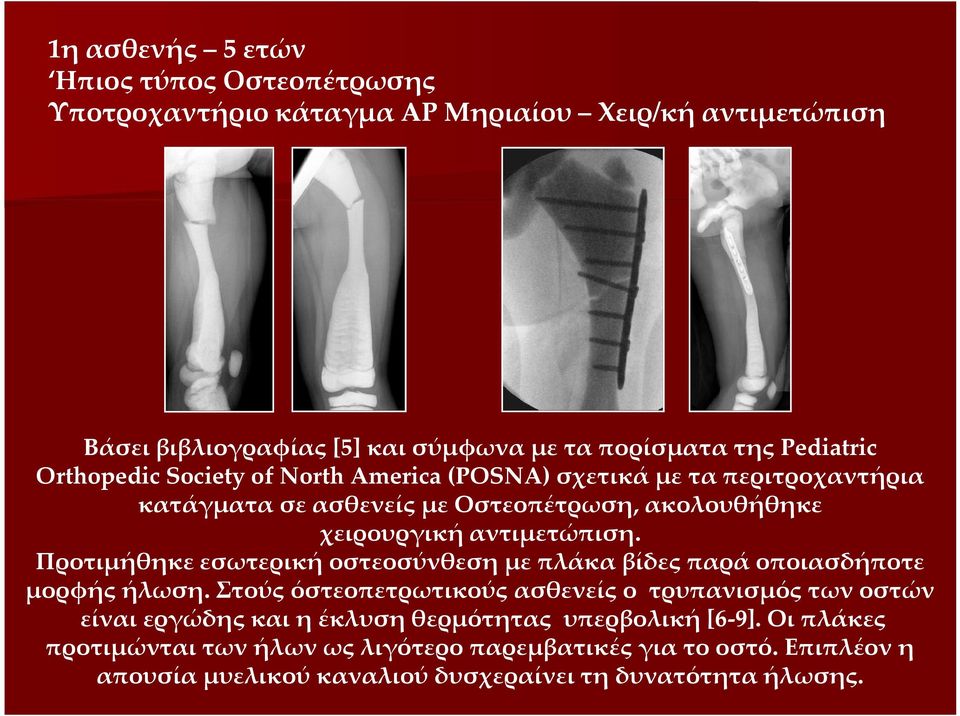 Προτιμήθηκε εσωτερική οστεοσύνθεση με πλάκα βίδες παρά οποιασδήποτε μορφής ήλωση.