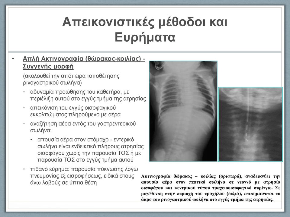 ενδεικτικό πλήρους ατρησίας οισοφάγου χωρίς την παρουσία ΤΟΣ ή με παρουσία ΤΟΣ στο εγγύς τμήμα αυτού πιθανό εύρημα: παρουσία πύκνωσης λόγω πνευμονίας εξ εισροφήσεως, ειδικά στους άνω λοβούς σε ύπτια