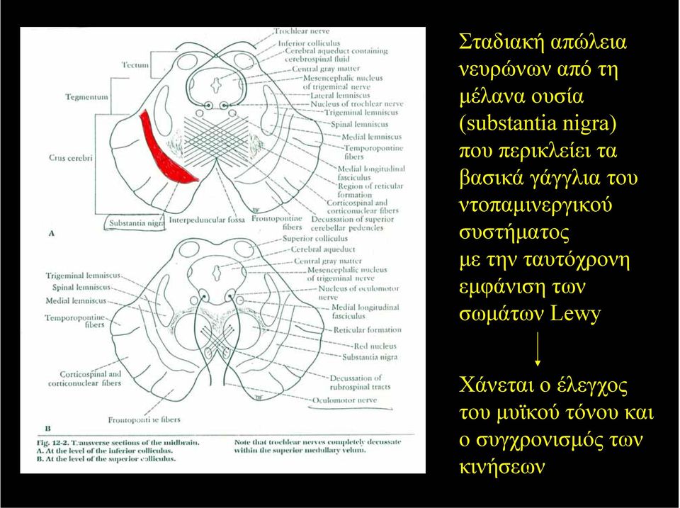 συστήµατος µε την ταυτόχρονη εµφάνιση των σωµάτων Lewy