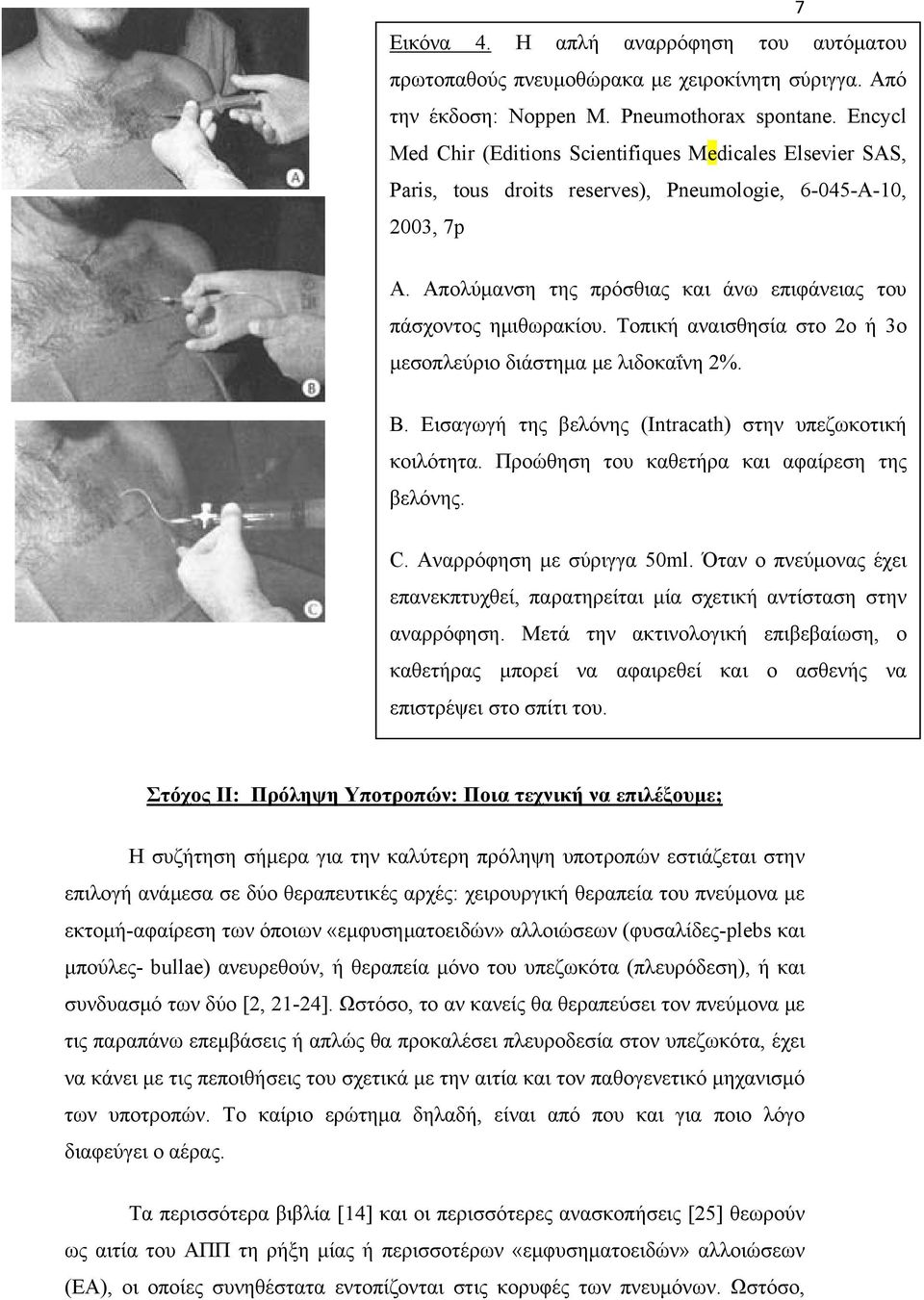 Τοπική αναισθησία στο 2ο ή 3ο μεσοπλεύριο διάστημα με λιδοκαΐνη 2%. Β. Εισαγωγή της βελόνης (Intracath) στην υπεζωκοτική κοιλότητα. Προώθηση του καθετήρα και αφαίρεση της βελόνης. C.