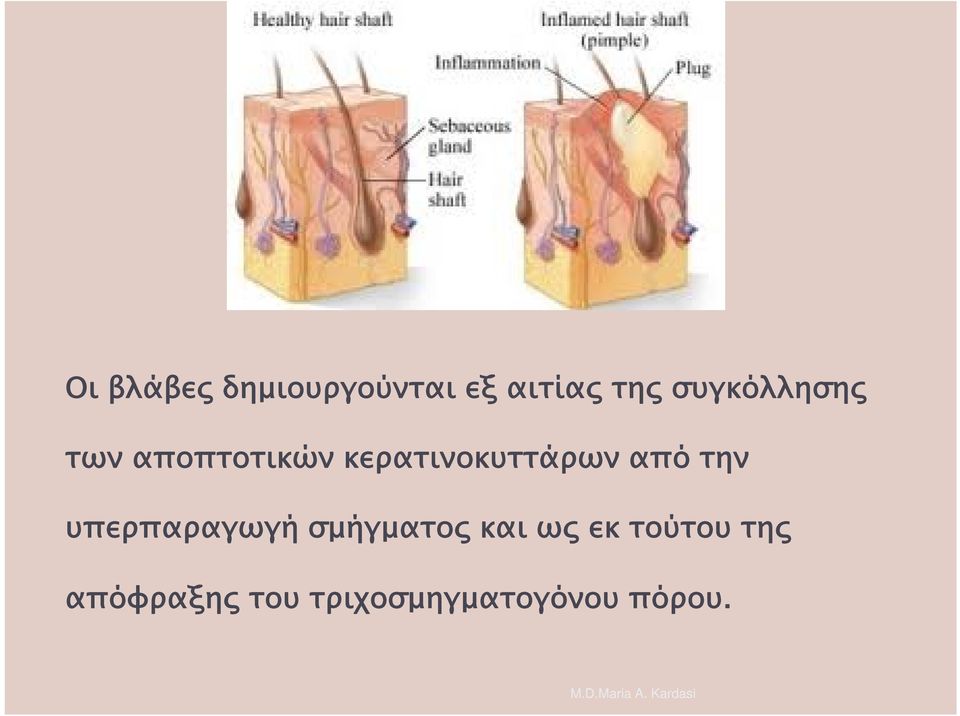 κερατινοκυττάρων από την υπερπαραγωγή