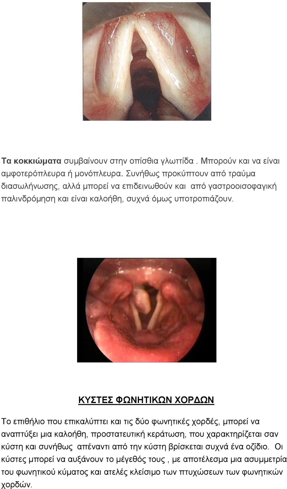 ΚΥΣΤΕΣ ΦΩΝΗΤΙΚΩΝ ΧΟΡΔΩΝ Το επιθήλιο που επικαλύπτει και τις δύο φωνητικές χορδές, μπορεί να αναπτύξει μια καλοήθη, προστατευτική κεράτωση, που χαρακτηρίζεται