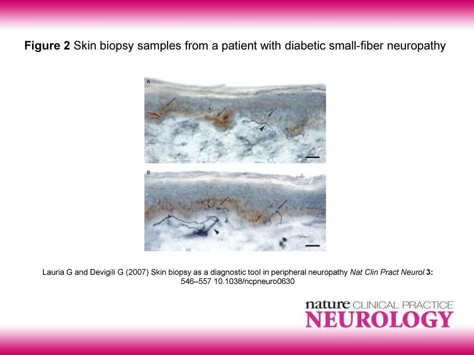 (2007) Skin biopsy as a diagnostic tool in peripheral