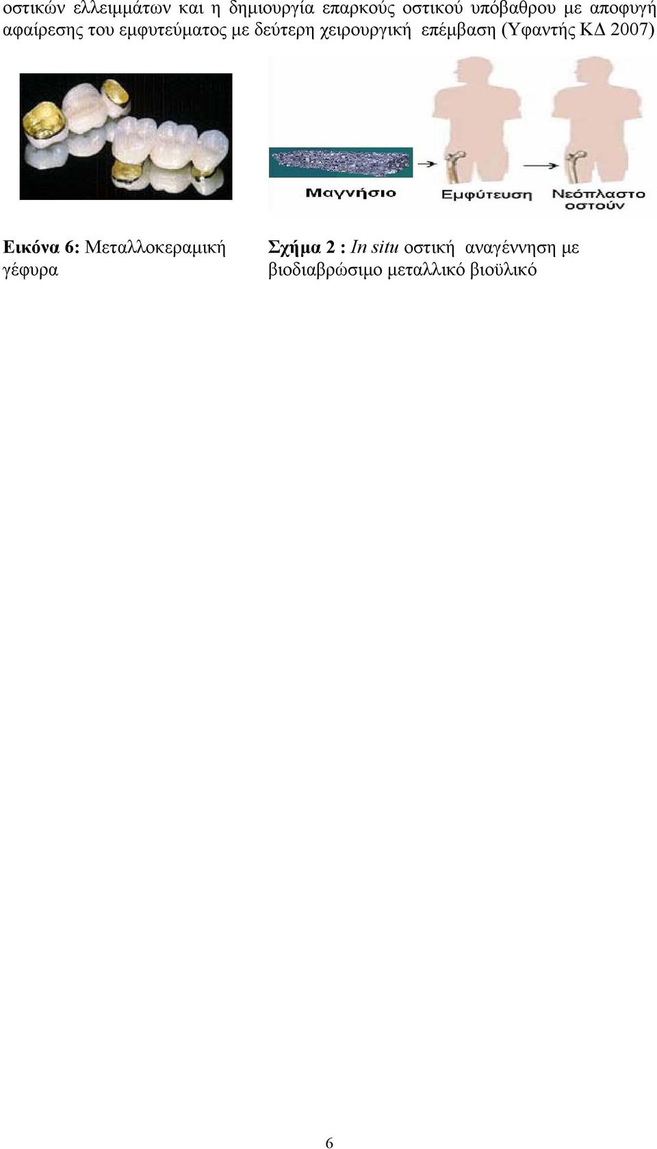 επέμβαση (Υφαντής ΚΔ 2007) Εικόνα 6: Μεταλλοκεραμική γέφυρα