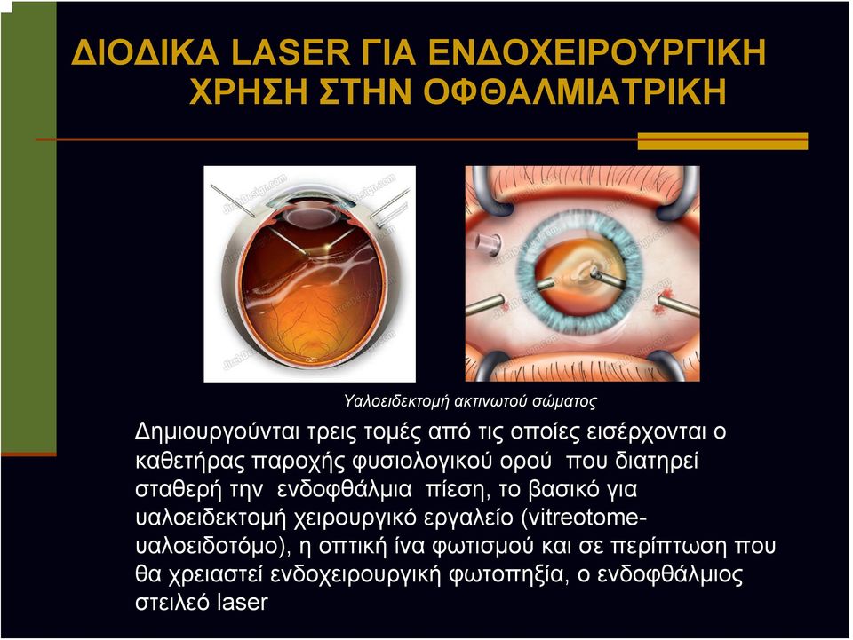 διατηρεί σταθερή την ενδοφθάλμια πίεση, το βασικό για υαλοειδεκτομή χειρουργικό εργαλείο