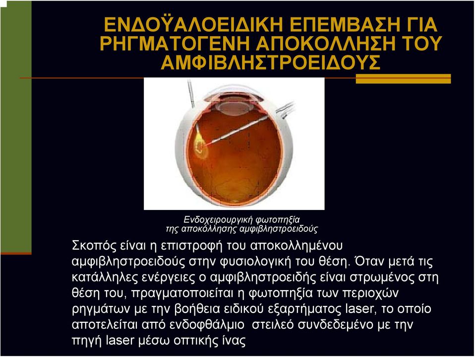 Όταν μετά τις κατάλληλες ενέργειες ο αμφιβληστροειδής είναι στρωμένος στη θέση του, πραγματοποιείται η φωτοπηξία των