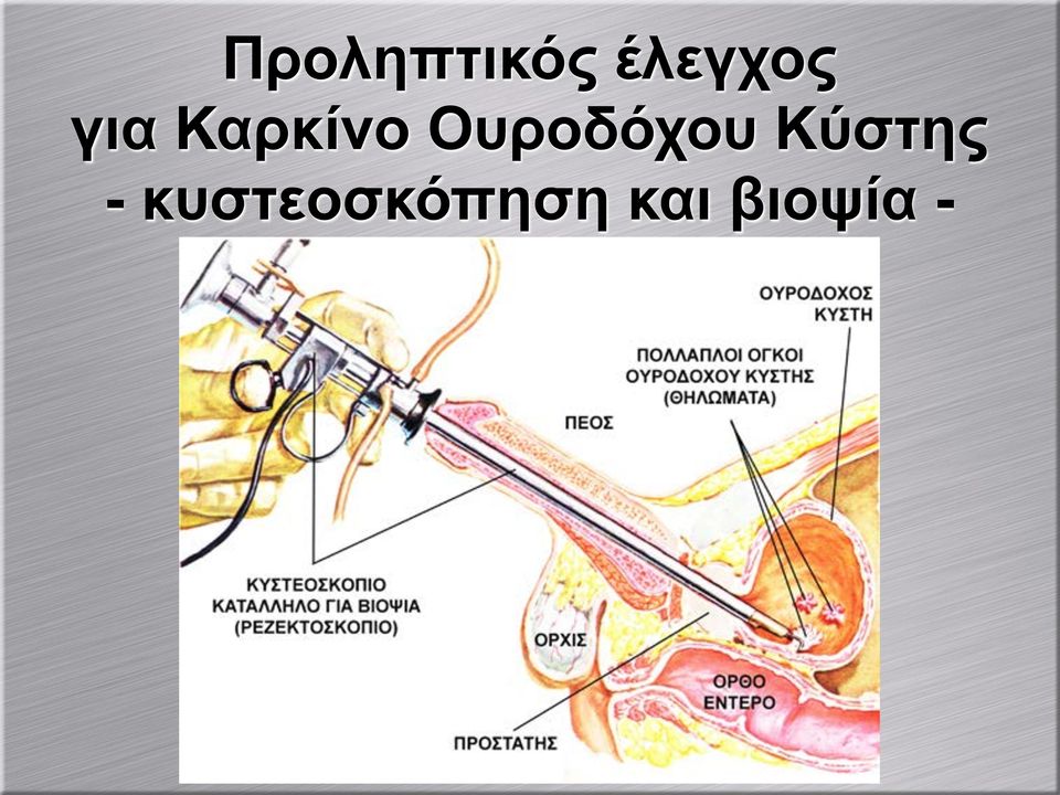 Ουροδόχου Κύστης -