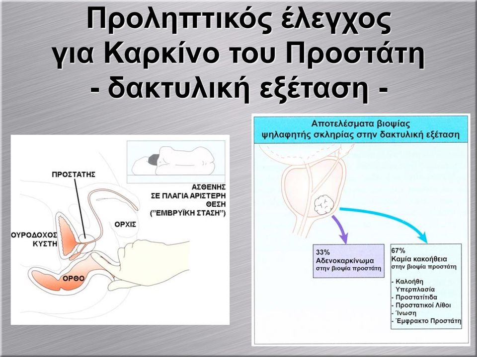 Καρκίνο του