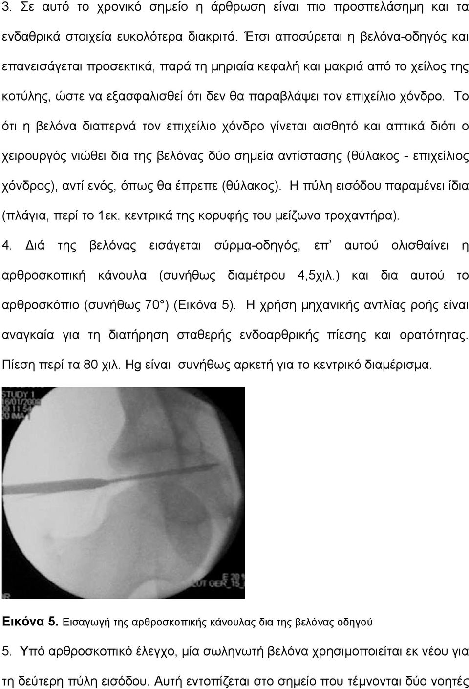 Το ότι η βελόνα διαπερνά τον επιχείλιο χόνδρο γίνεται αισθητό και απτικά διότι ο χειρουργός νιώθει δια της βελόνας δύο σημεία αντίστασης (θύλακος - επιχείλιος χόνδρος), αντί ενός, όπως θα έπρεπε