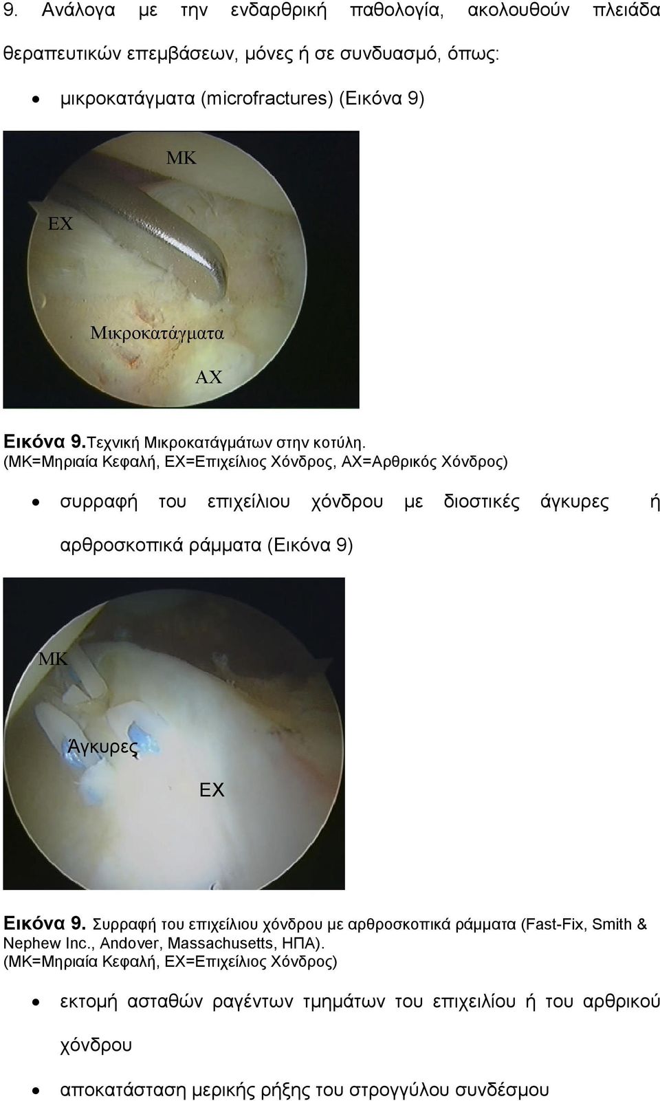 (=Μηριαία Κεφαλή, ΕΧ=Επιχείλιος Χόνδρος, ΑΧ=Αρθρικός Χόνδρος) συρραφή του επιχείλιου χόνδρου με διοστικές άγκυρες ή αρθροσκοπικά ράμματα (Εικόνα 9) Άγκυρες ΕΧ Εικόνα 9.