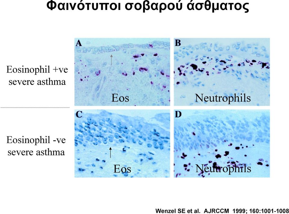 Eosinophil -ve severe asthma Eos