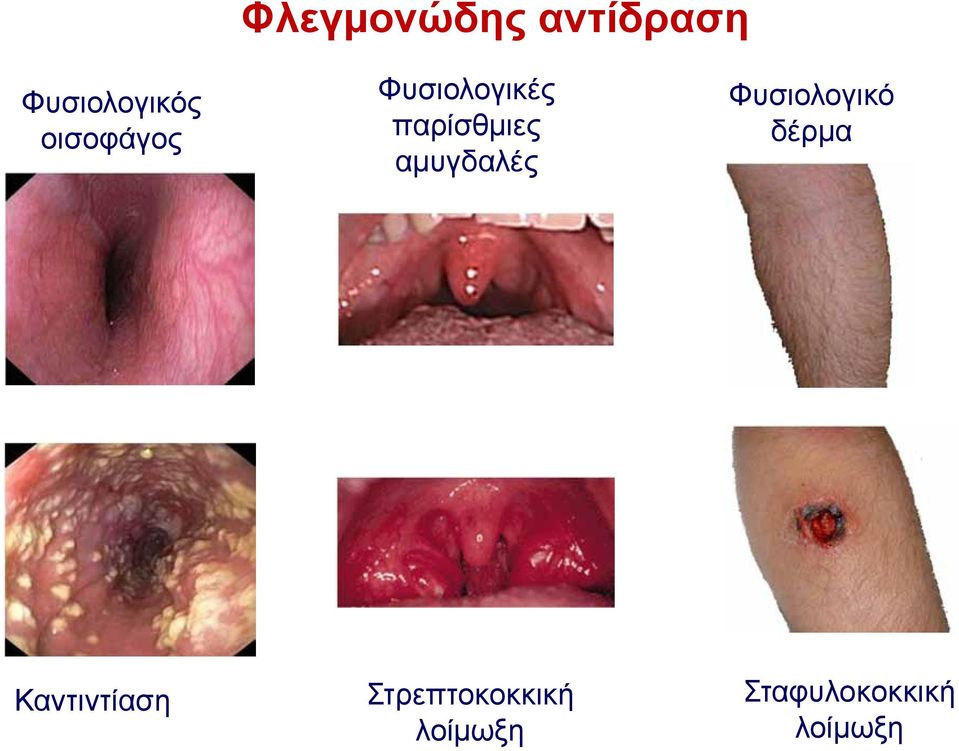 αμυγδαλές Φυσιολογικό δέρμα