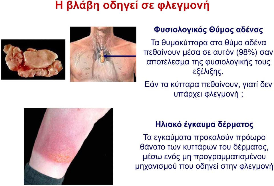 Εάν τα κύτταρα πεθαίνουν, γιατί δεν υπάρχει φλεγμονή ; Ηλιακό έγκαυμα δέρματος Τα εγκαύματα