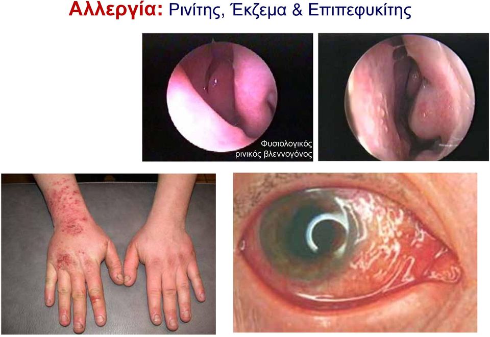 Επιπεφυκίτης
