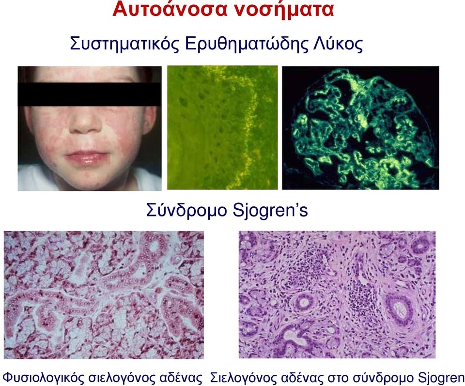 Sjogren s Φυσιολογικός σιελογόνος
