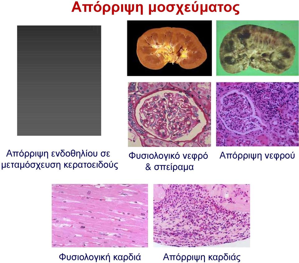 κερατοειδούς Φυσιολογικό νεφρό &