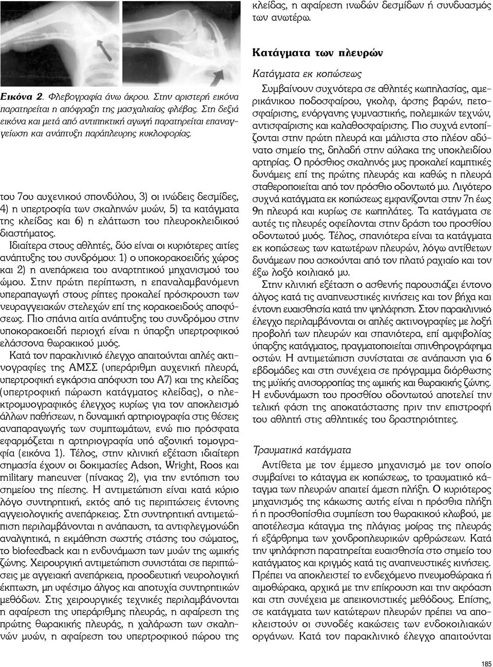 του 7ου αυχενικού σπονδύλου, 3) οι ινώδεις δεσμίδες, 4) η υπερτροφία των σκαληνών μυών, 5) τα κατάγματα της κλείδας και 6) η ελάττωση του πλευροκλειδικού διαστήματος.