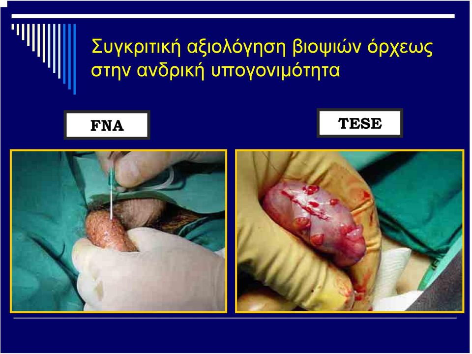 βιοψιών όρχεως