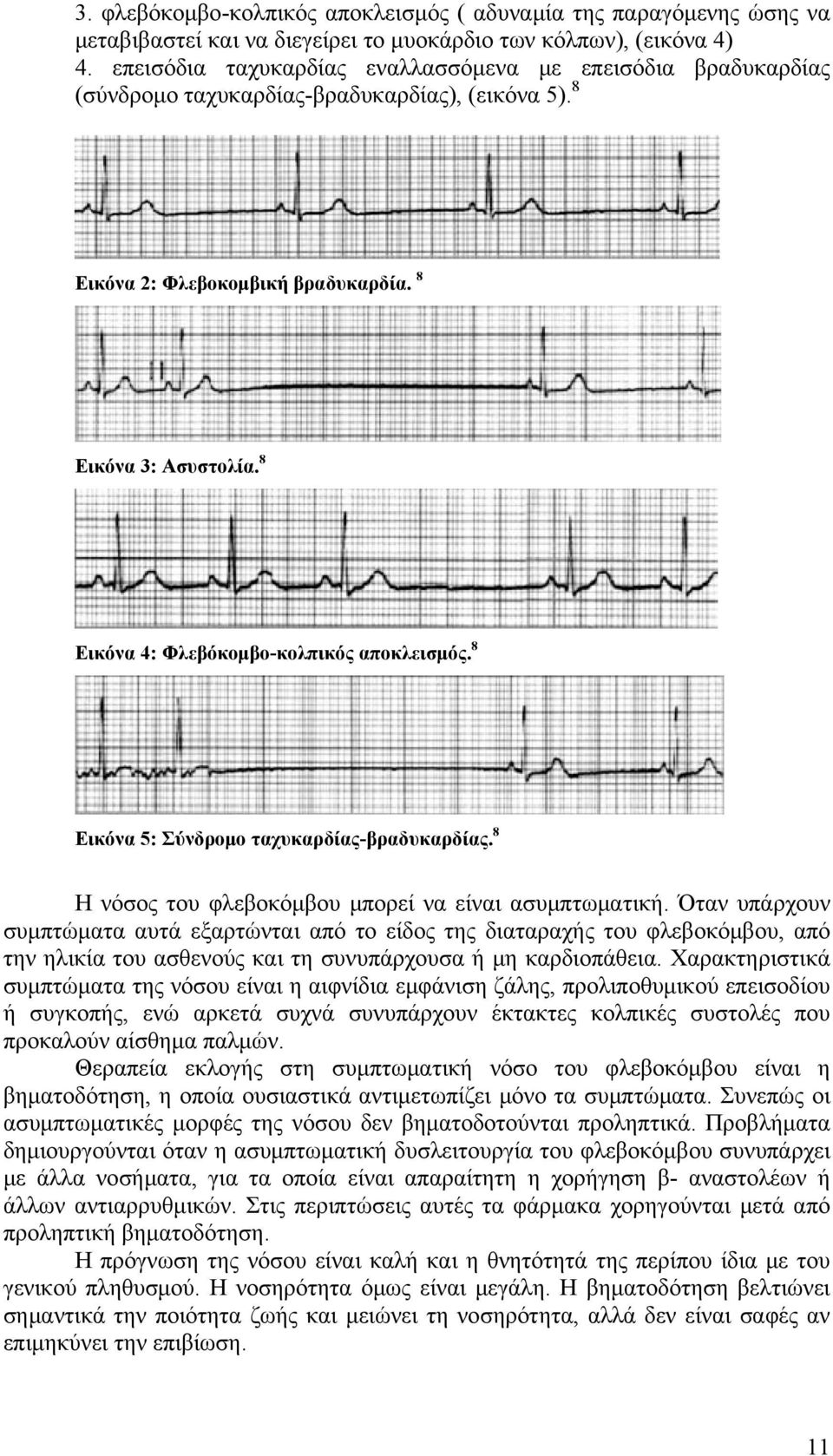 8 Εικόνα 4: Φλεβόκομβο-κολπικός αποκλεισμός. 8 Εικόνα 5: Σύνδρομο ταχυκαρδίας-βραδυκαρδίας. 8 Η νόσος του φλεβοκόμβου μπορεί να είναι ασυμπτωματική.