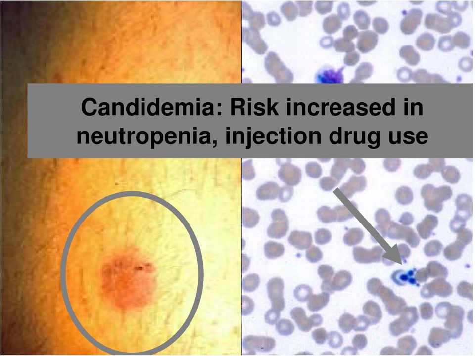 neutropenia, injection