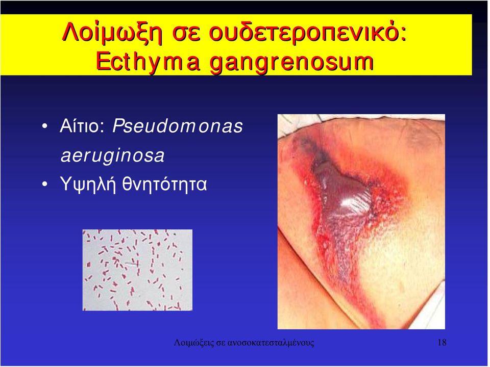 Pseudomonas aeruginosa Υψηλή