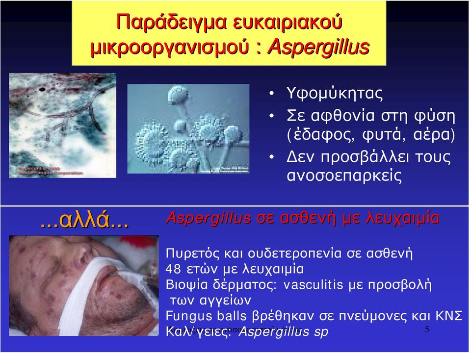 .. Aspergillus σε ασθενή με λευχαιμία Πυρετός και ουδετεροπενία σε ασθενή 48 ετών με λευχαιμία