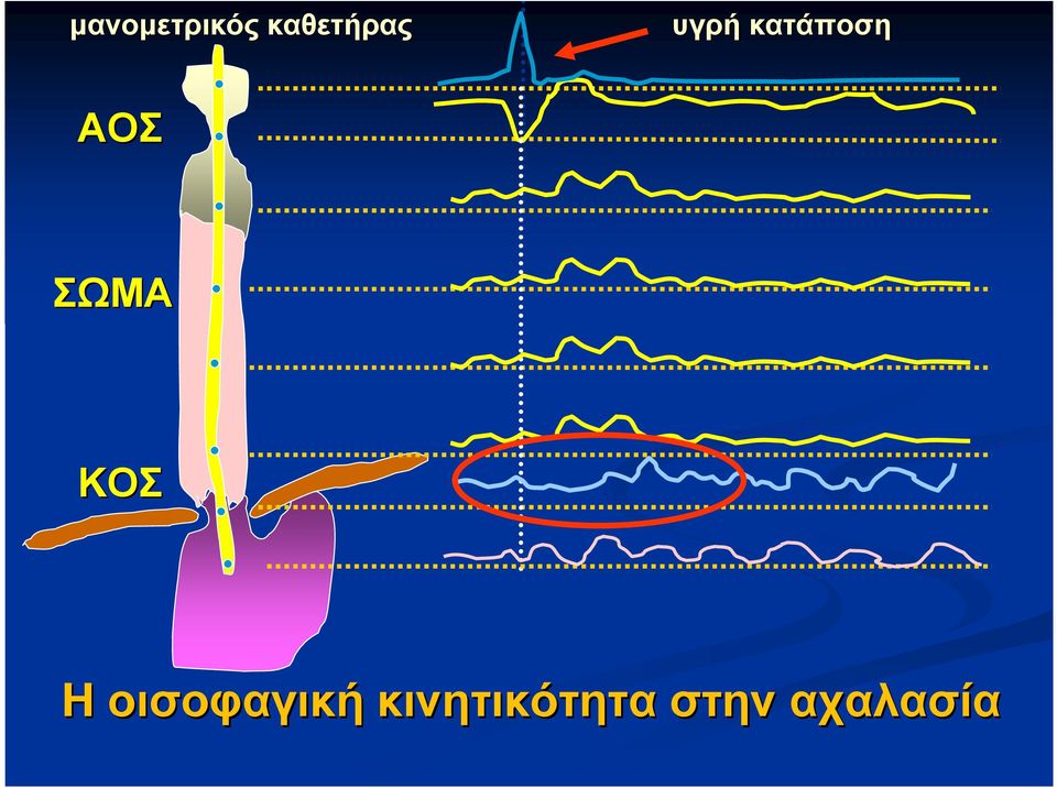 ΚΟΣ Η οισοφαγική