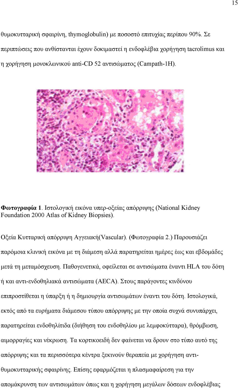 Ιστολογική εικόνα υπερ-οξείας απόρριψης (National Kidney Foundation 2000 Atlas of Kidney Biopsies). Οξεία Κυτταρική απόρριψη Αγγειακή(Vascular). (Φωτογραφία 2.