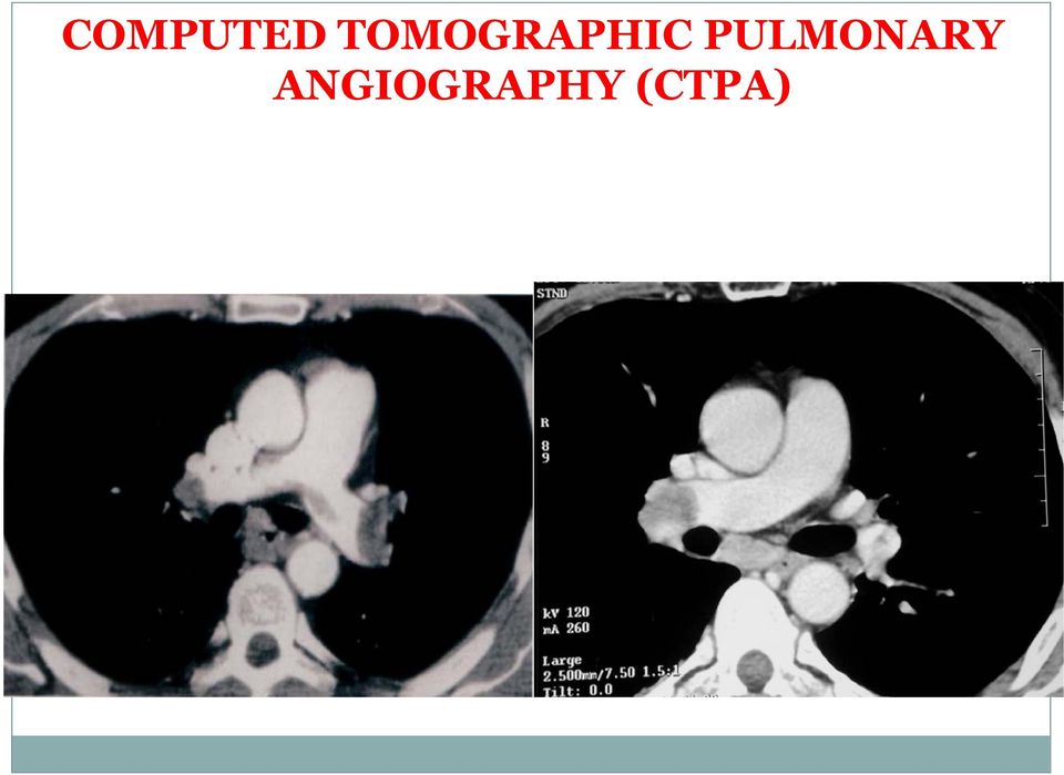 PULMONARY