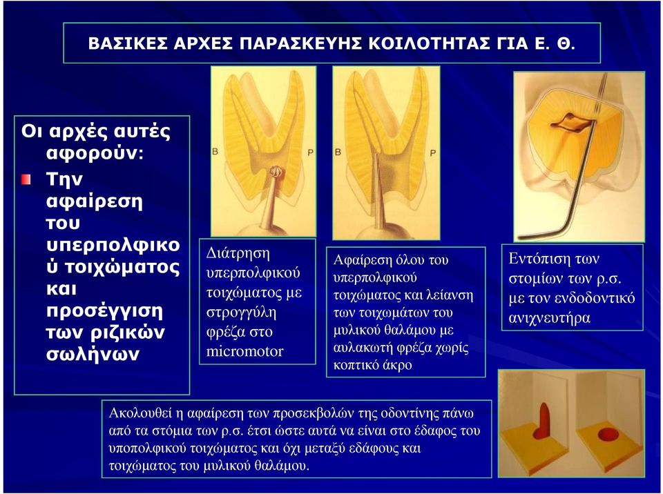 φρέζα στο micromotor Αφαίρεση όλου του υπερπολφικού τοιχώματος και λείανση των τοιχωμάτων του μυλικού θαλάμου με αυλακωτή φρέζα χωρίς κοπτικό άκρο