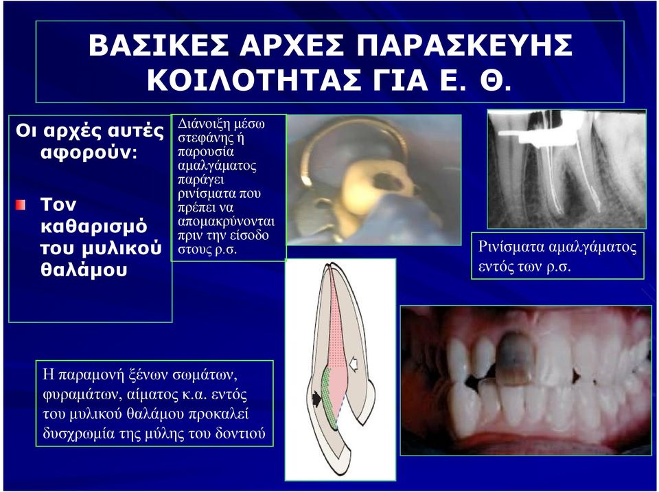 αμαλγάματος παράγει ρινίσματα που πρέπει να απομακρύνονται πριν την είσοδο στους ρ.σ. Ρινίσματα αμαλγάματος εντός των ρ.