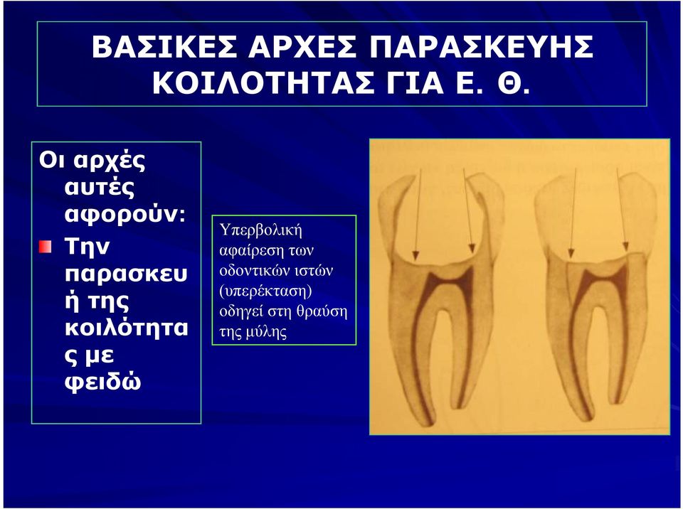 κοιλότητα ς με φειδώ Υπερβολική αφαίρεση των