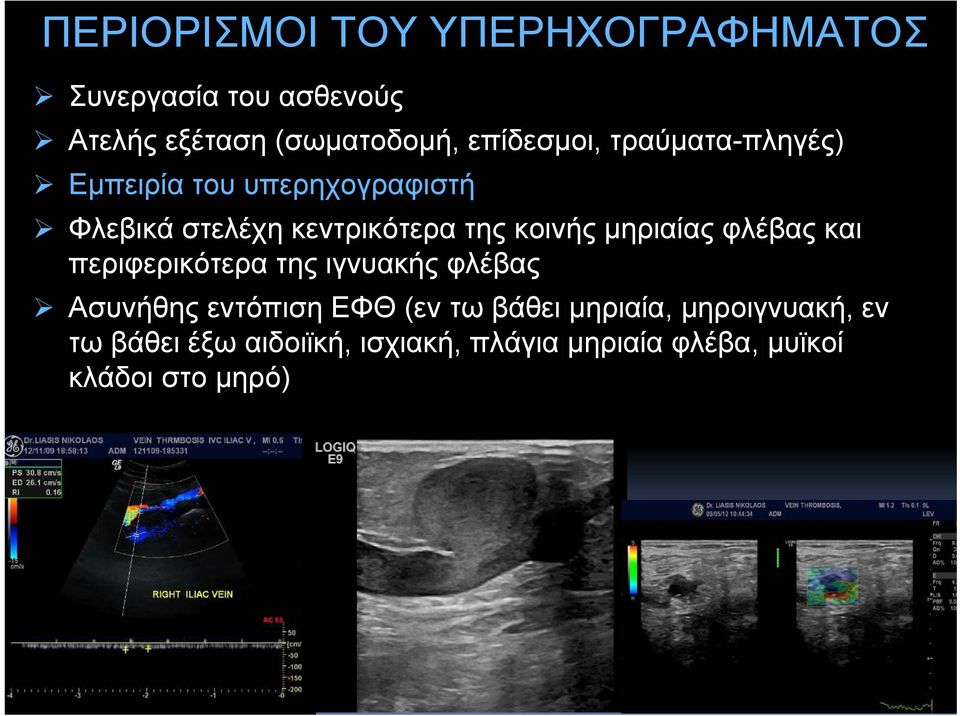 κοινής μηριαίας φλέβας και περιφερικότερα της ιγνυακής φλέβας Ασυνήθης εντόπιση ΕΦΘ (εν τω