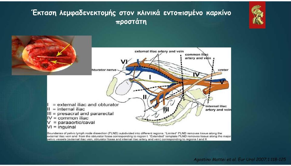 προστάτη Agostino Mattei et