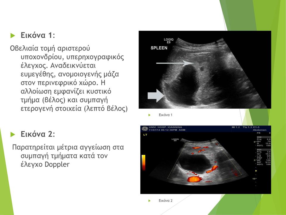 Η αλλοίωση εμφανίζει κυστικό τμήμα (βέλος) και συμπαγή ετερογενή στοιχεία (λεπτό