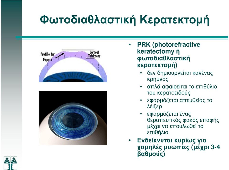 κερατοειδούς εφαρµόζεται απευθείας το λέιζερ εφαρµόζεται ένας θεραπευτικός φακός