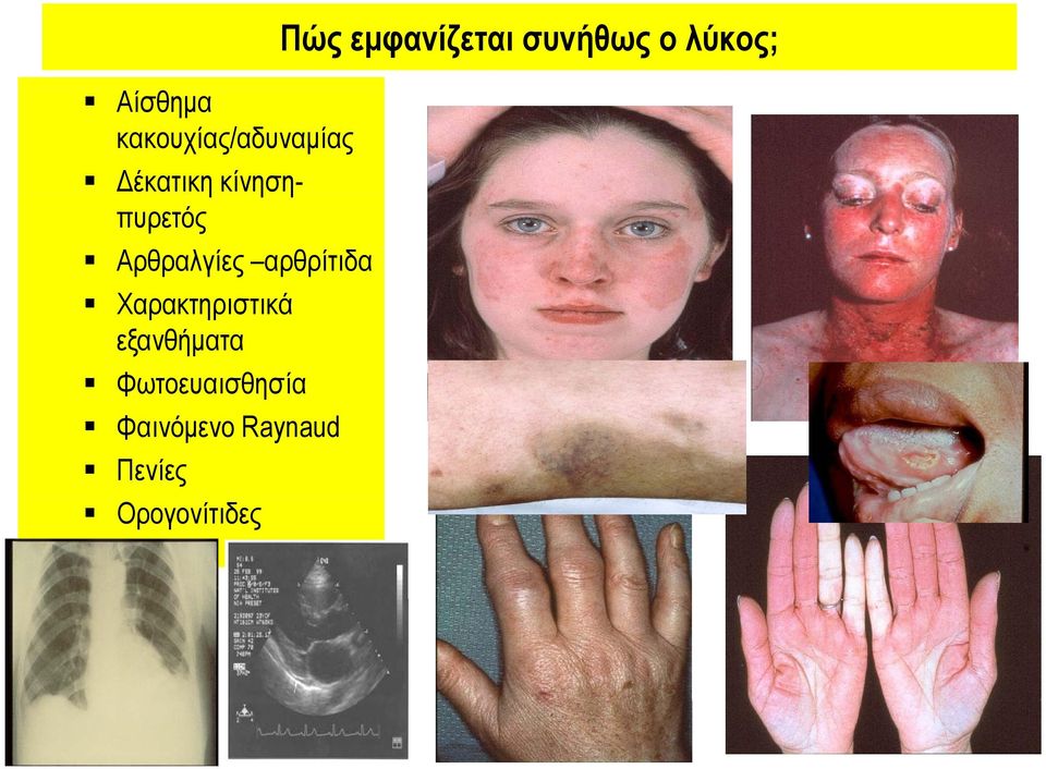 εξανθήματα Φωτοευαισθησία Φαινόμενο Raynaud