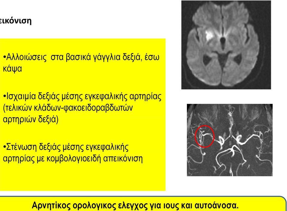 δεξιάς μέσης εγκεφαλικής αρτηρίας (τελικών κλάδων-φακοειδοραβδωτών