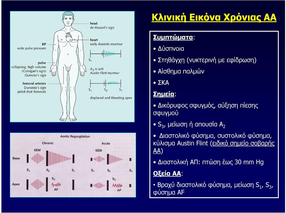 Διαστολικό φύσημα, συστολικό φύσημα, κύλισμα Austin Flint (ειδικό σημείο σοβαρής ΑΑ)